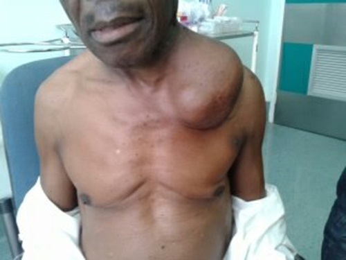 Virchow es un ganglio supraclavicular izquierdo y se asocia con metástasis de un primario gastrointestinal. NÃ³dulo de Virchow gigante como presentaciÃ³n inicial de un