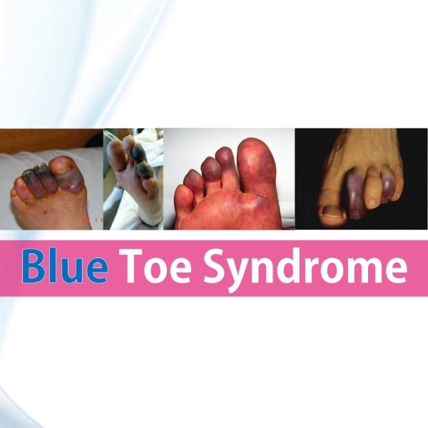 Blue Toe Syndrome Occlusive Vasculopathy Rish Academy