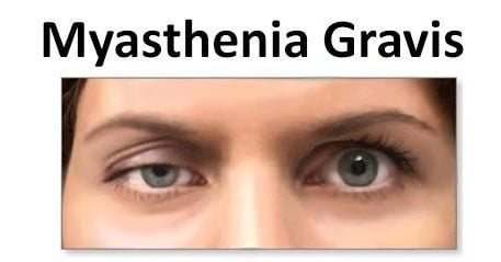 Drooping of one or both eyelids. Sagliklimiyim.Com: Myastenia Gravis Nedir, Belirtileri ...