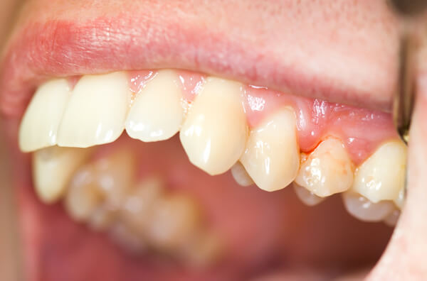 Sonhar com dente sangrando - O que significa? Respostas, aqui!