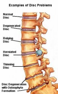 Spondylosis, Spondyloarthrosis | SpineTech