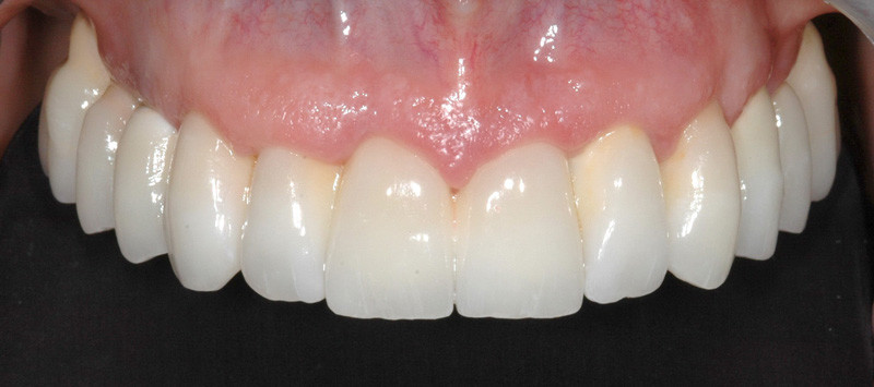 Dei due elementi ai lati dello spazio lasciato vuoto, il dente che si sposta in . Toronto bridge. Denti fissi su impianti per un'intera