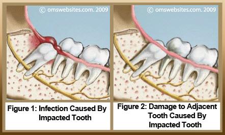 This process can be long and painful and . Wisdom Teeth Extraction Services Melbourne
