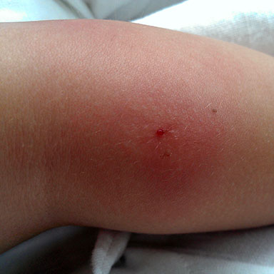 Despite their name, they can live practically anywhere, like on b. What Bit Me? Identifying Different Bug Bites - Valley Pest