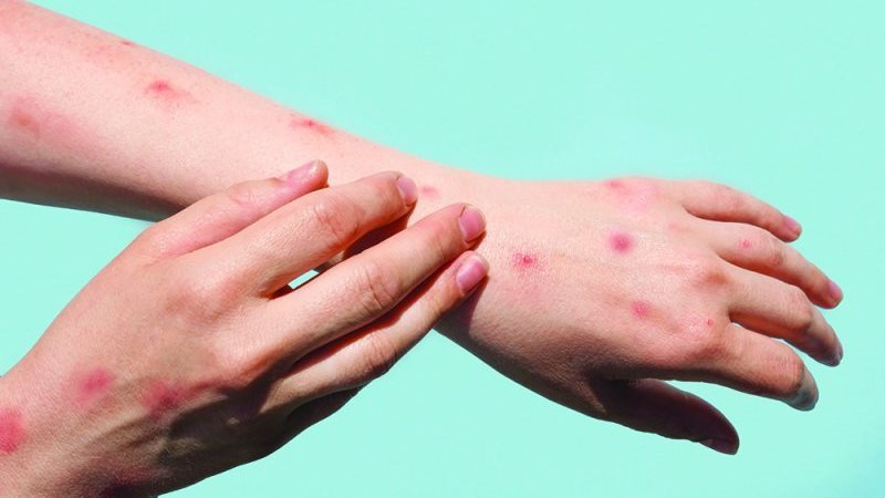 أكثر عرضة للإصابة، الصحة تحذر هؤلاء من فيروس جدري القرود 