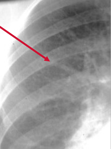 Find the bottleneck in your industry. Cephalization on chest x-ray - wikidoc