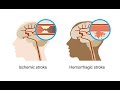 Recognizing hemorrhagic strokes–Neurology Masterclass