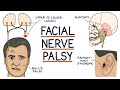 Understanding Facial Nerve Palsy (Facial Weakness)