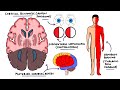 Posterior Cerebral Artery Stroke Syndromes | PCA Stroke Syndromes | Stroke Syndromes