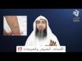 الكدمات.. الخدوش والخربشات ⁉️ - د. حسن الجبيلي