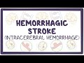 Hemorrhagic stroke: intracerebral hemorrhage - causes, symptoms, diagnosis, treatment, pathology