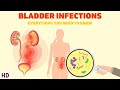 Bladder Infections: The Silent Epidemic Affecting Millions of Women!