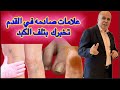 إذا ظهرت هذه العلامات على قدمك، فالكبد في خطر