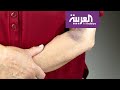 صباح العربية | ما سبب ظهور البقع الزرقاء تحت الجلد؟