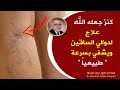 كنز جعله الله علاج دوالي الساقين ويشفي بسرعة طرق طبيعية لمحاربة الأوردة العنكبوتية ودوالي الساقين