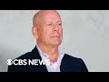 What is aphasia? Bruce Willis diagnosed with condition that affects communication