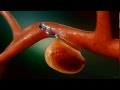 Aneurysm Clipping Surgery - Animation