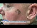 Doctor spots man's melanoma on a train