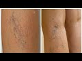 أسباب وعلاج الشعيرات الدموية فى الساق التى تشبه الدوالى