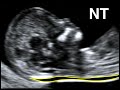 How to perform Nuchal Translucency Scan