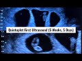 Our First Ultrasound at 5 Weeks \u0026 5 Days! It's Five?? ***Finding Out We Were Having Quintuplets