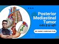 पोस्टीरियर मेडियास्टाइनम गंभीर है या नहीं? DR HARSH VARDHAN PURI