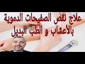 علاج نقص الصفائح الدموية بالأعشاب و الطب البديل للحوامل