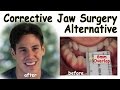 Corrective Jaw Surgery Alternative - Underbite Correction without Surgery