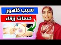 كدمات زرقاء في الجسم بدون سبب