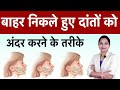 बाहर निकले हुये दांत को इन तरीकों से अंदर करें | Outward Proclined Teeth problem and solution |