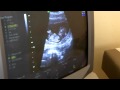 Susan's Ultrasound / Nuchal Translucency Test -  5-20-2010