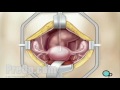 Hysterectomy Removal of Uterus, Ovaries and Fallopian Tubes Surgery PreOp® Patien Education