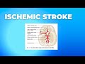 Ischemic stroke