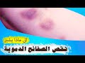 الى ماذا يشير نقص الصفائح الدموية ؟