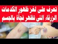 تعرف على لغز ظهور الكدمات الزرقاء التى تظهر فجأة بالجسم