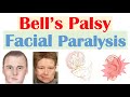 Bell’s Palsy (Facial Paralysis) | Causes, Pathophysiology, Signs \u0026 Symptoms, Diagnosis, Treatment