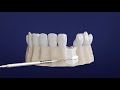 Step by Step Guide to Your Dental Implant Procedure