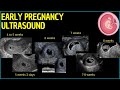 Early Pregnancy Ultrasound: A Deep Dive into First Trimester Insights #pregnancyultrasound