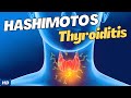 Hashimoto's Disease: Causes, Symptoms and Treatment