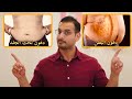 الفرق بين دهون البطن ودهون تحت الجلد، الطريقة الصحيحة للتخلص منها