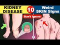 Skin signs of Kidney Disease | Chronic Kidney Disease | Kidney Failure Symptoms | CKD