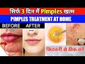 सिर्फ 3 दिन Use कर लो Acne, Pimple, Tiny Bumps खत्म / How To Remove DARK SPOTS From Face Naturally