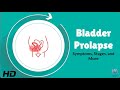 Bladder Prolapse 101: Causes, Symptoms, and Fixes