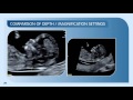 Measuring Nuchal Translucency and Crown Rump Length: 12–13 weeks scan