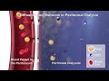 Satellite Healthcare | PD | Diffusion \u0026 Osmosis | 3D Animation