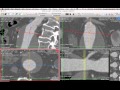 EVAR Planning - Centerline for Aortic \u0026 Total Length - How I do it with Osirix