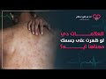 نقص الصفائح الدموية وارتفاعها وتأثيرها على القلب وباقي الجسم | سامح علام