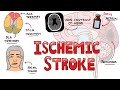 Acute Ischemic Stroke - Signs and Symptoms (Stroke Syndromes) | Causes \u0026 Mechanisms | Treatment