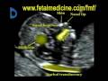 Fetal Medicine Foundation - Nuchal translucency