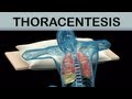 Thoracentesis Medical Animation